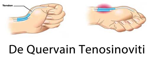 De Quervain Tenosinoviti
