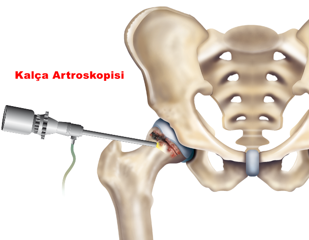 Kalça Osteotomileri