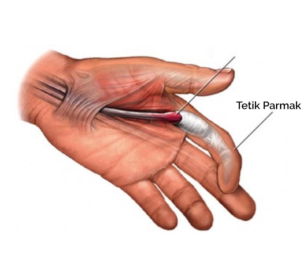 Tetik parmak hastalığı